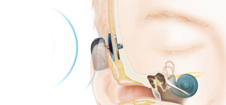 Rozpoczynamy wszczepianie implantów słuchowych zakotwiczonych w kości!