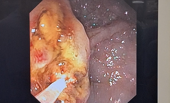 Pierwszy taki zabieg w Polsce i jeden z pierwszych na świecie